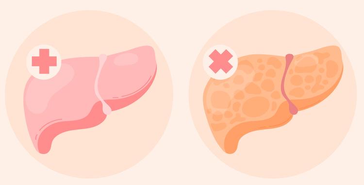 Nova diretriz sobre doença hepática gordurosa não alcoólica e risco cardiovascular