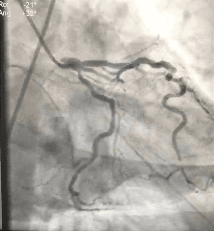 Novo guideline europeu de SCA sem supra: resumão parte 1