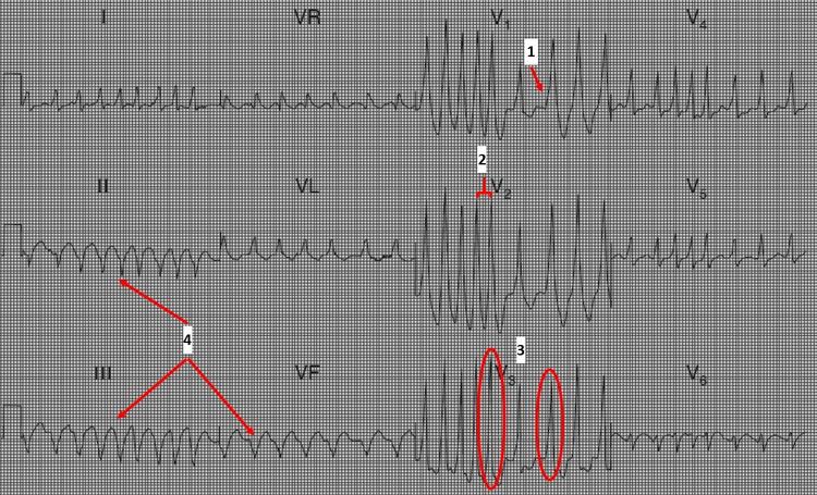 Você Sabe Diferenciar um ECG de FA + Bloqueio de Ramo x FA + W.P.W.?