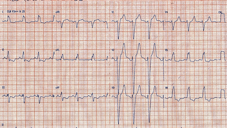 Como avaliar o intervalo QT no paciente com bloqueio de ramo?