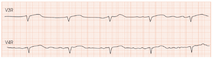 Ausência de supra de ST em V3R e V4R descarta IAM de VD?