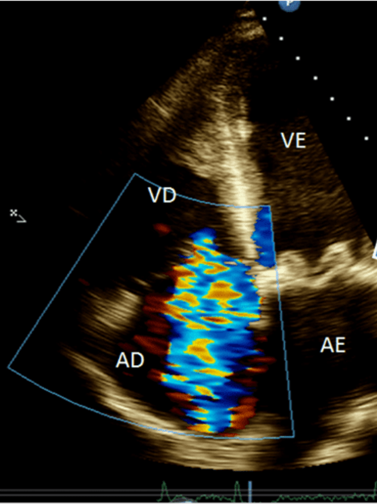 Insuficiência tricúspide: já ouviu falar na TricValve?