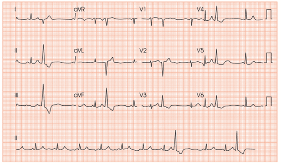 Extrassístoles Ventriculares em Paciente Assintomático: O Que Fazer?