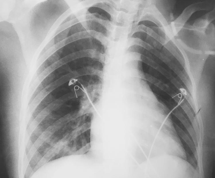 Tratamento da estenose mitral: como fazer?