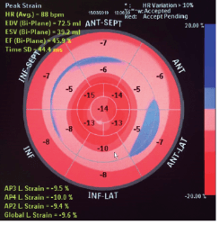 O ecocardiograma na amiloidose: quais os achados típicos?