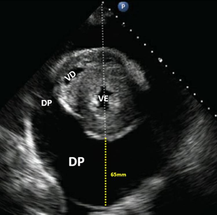 Como avaliar derrame pericárdico usando metodologia POCUS ?