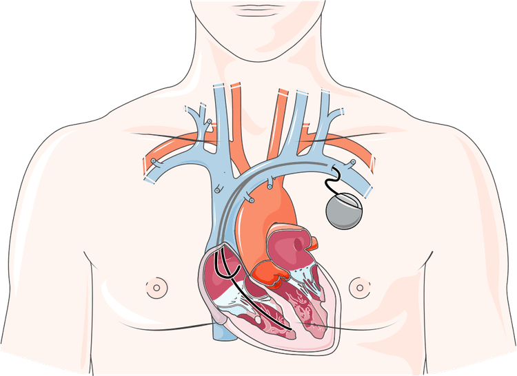 Quando Indicar Marca-passo na Doença do Nó Sinusal?