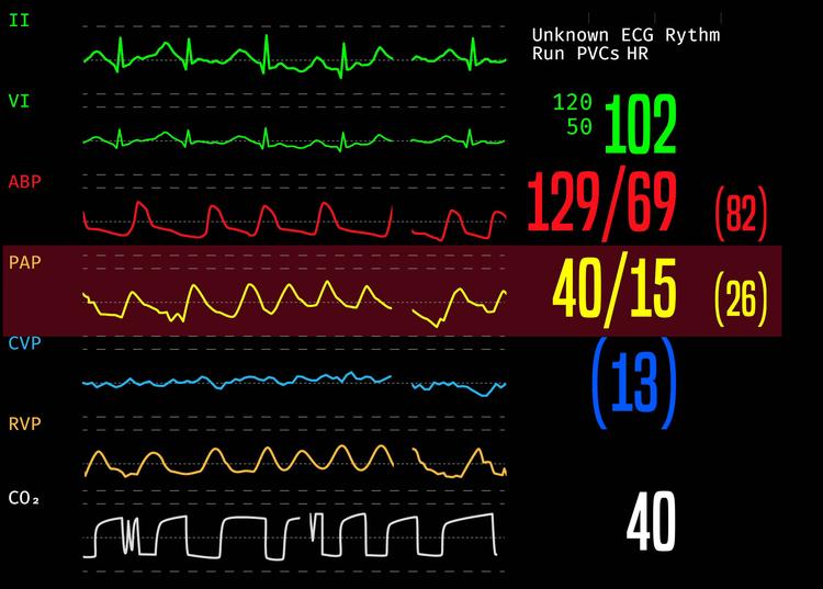O que você precisa saber sobre o cateter de artéria pulmonar Swan-Ganz?