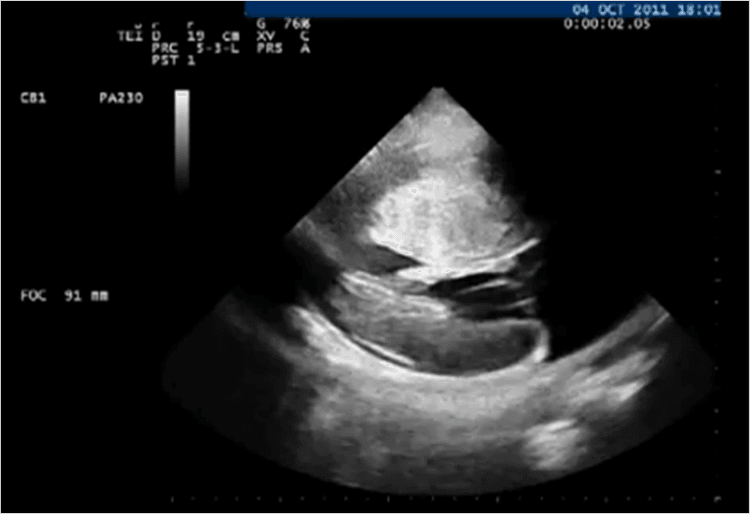 Mavacamten, uma nova terapia para pacientes sintomáticos com cardiomiopatia hipertrófica não obstrutiva?