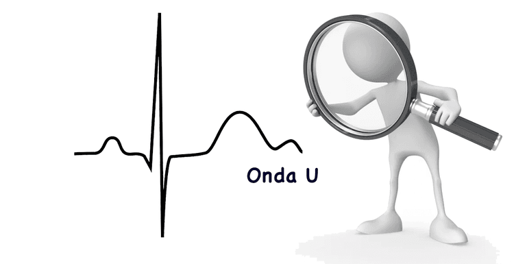 Onda U continua um enigma da eletrocardiografia! Fato ou Mito?