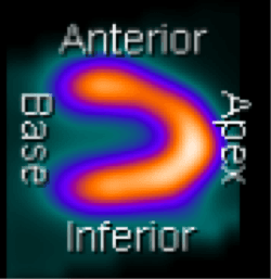 Como interpretar uma cintilografia miocárdica de forma simples?