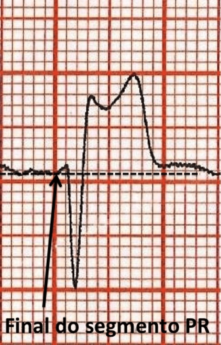 Quais as causas de supradesnivelamento do segmento de ST?