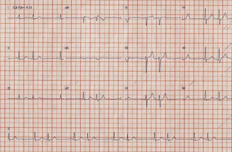 Extrassístoles Atriais em Paciente Assintomático: O Que Fazer?