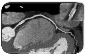 Reestenose de stent: o que eu preciso saber sobre o assunto?