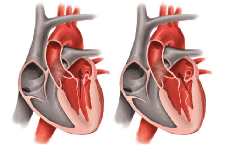 O que a nova diretriz diz sobre tratamento da insuficiência mitral?