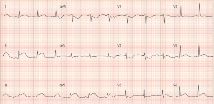 Quais as fases evolutivas de um infarto com supra de ST?
