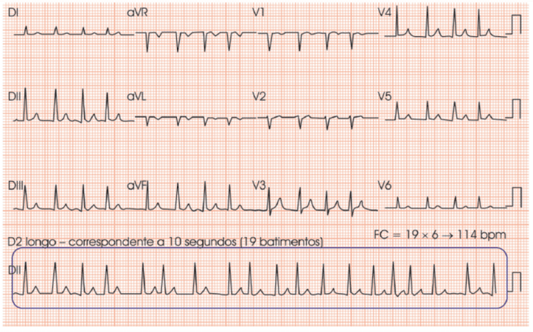 Já Viu as Novidades da Nova Diretriz de Fibrilação Atrial Americana?