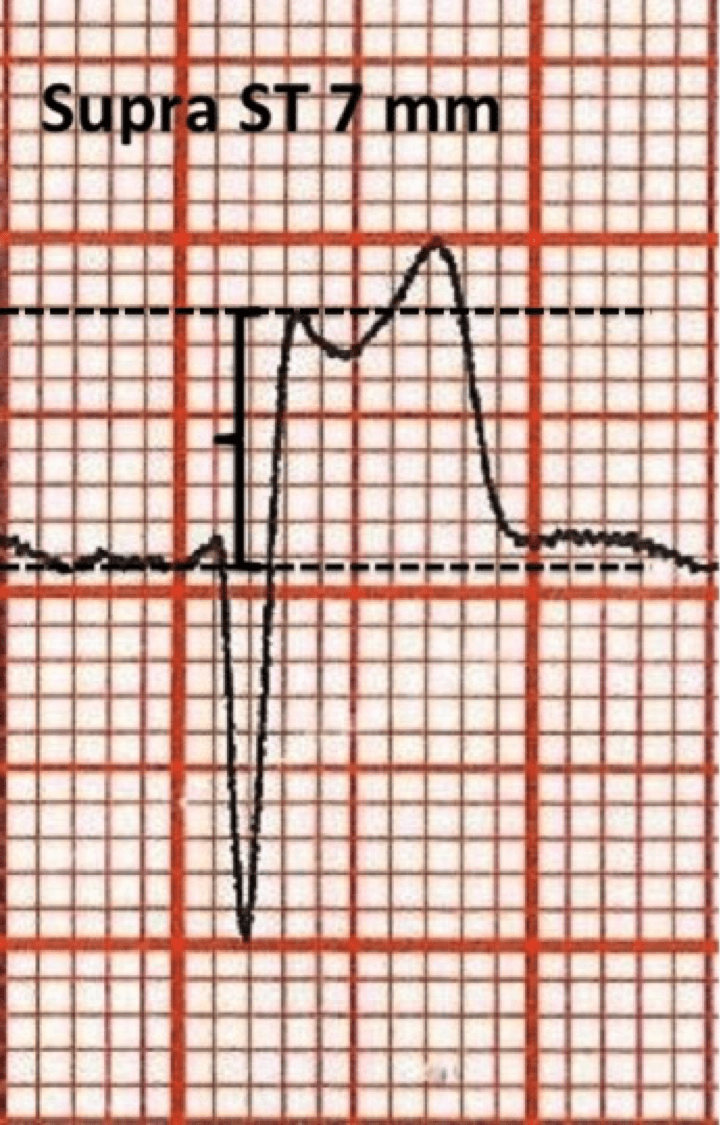 Como localizar a parede acometida por infarto com supra de ST?