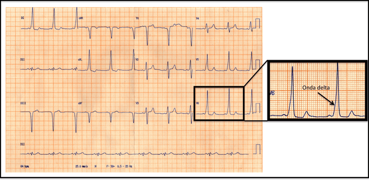Quais os critérios diagnósticos da síndrome de Wolff-Parkinson-White?
