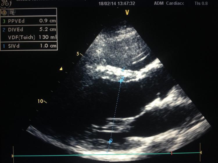 Novo guideline de medidas realizadas pelo ecocardiograma – o que mudou?
