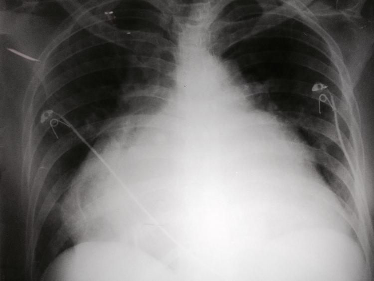 Quais os sinais de aumento do átrio esquerdo presentes nesta radiografia de tórax?