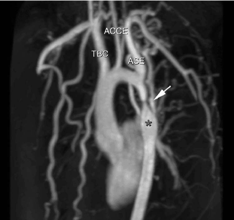 Coarctação de aorta: o que eu tenho que saber?