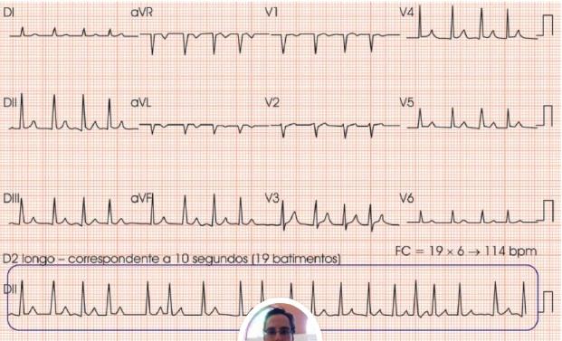 Qual o Risco de Mortalidade Após Ablação por Cateter de Fibrilação Atrial?