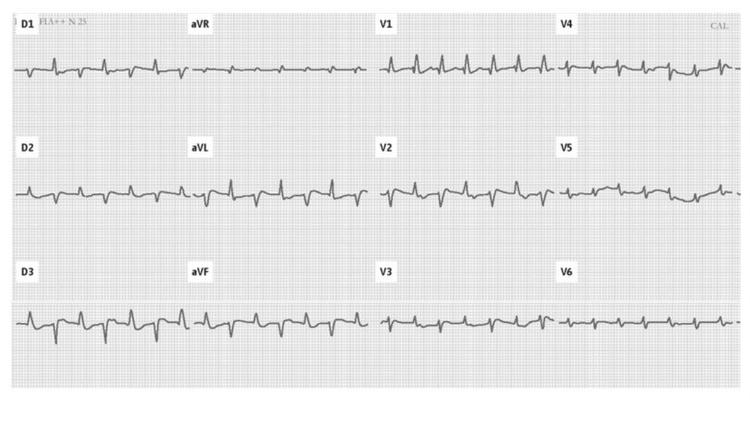 Intoxicação Digitálica: o que você precisa saber?