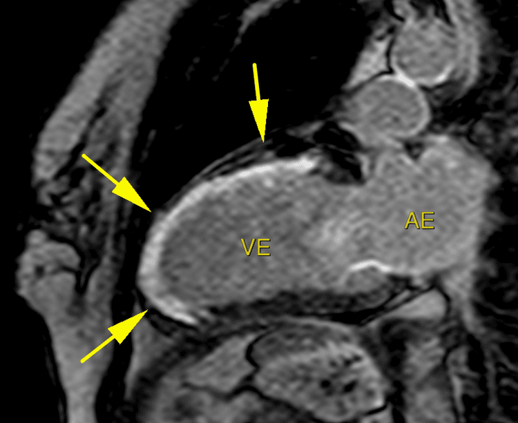 Onda Q no ECG = infarto prévio, certo? Está na hora de rever seus conceitos…