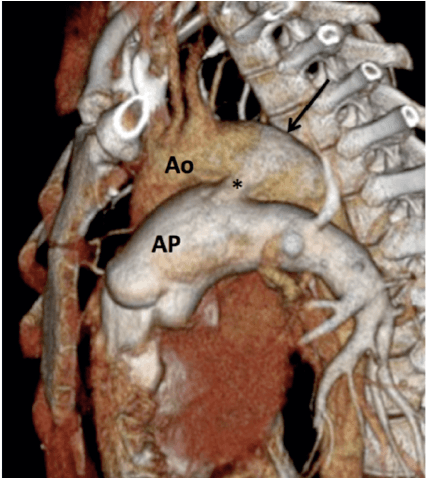 Persistência do canal arterial (PCA): o que eu tenho que saber?