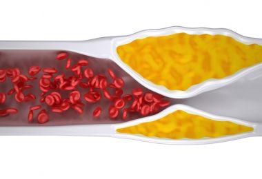 Elevação isolada de CKMB