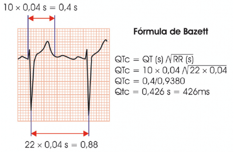 Intervalo QT: quais os valores normais?