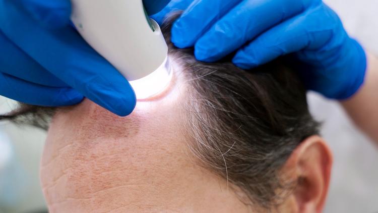 Recomendações do II Consenso Brasileiro de Alopecia Areata