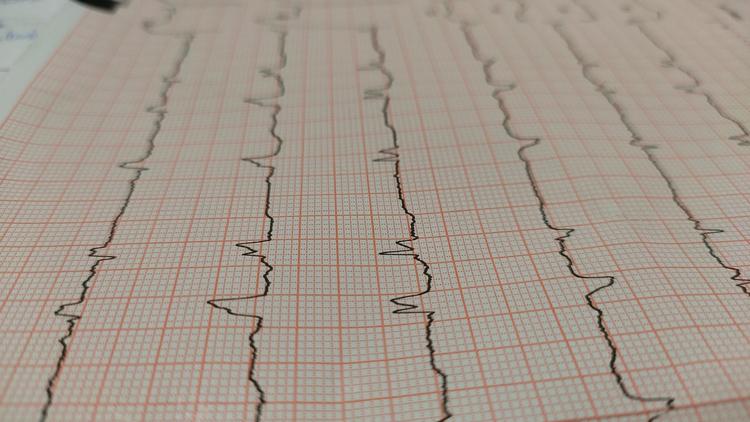 Interrupção da FA como um preditor para sucesso da ablação na FA persistente