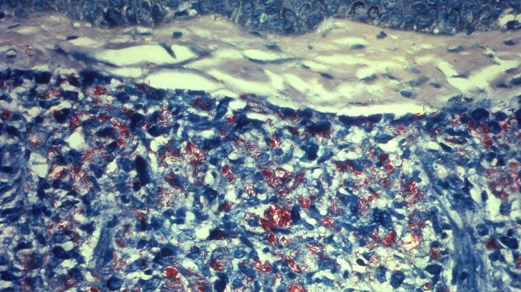 Quando suspeitar de síndrome de túnel do carpo secundária à hanseníase neural?