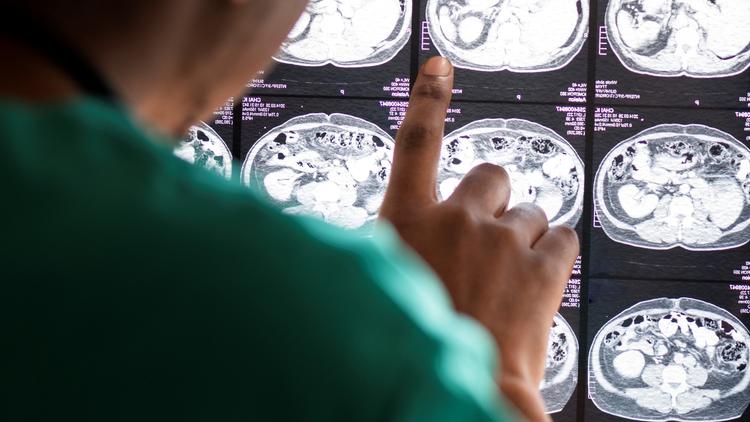 Série Parkinson: Quando indicar o tratamento cirúrgico na doença de Parkinson?