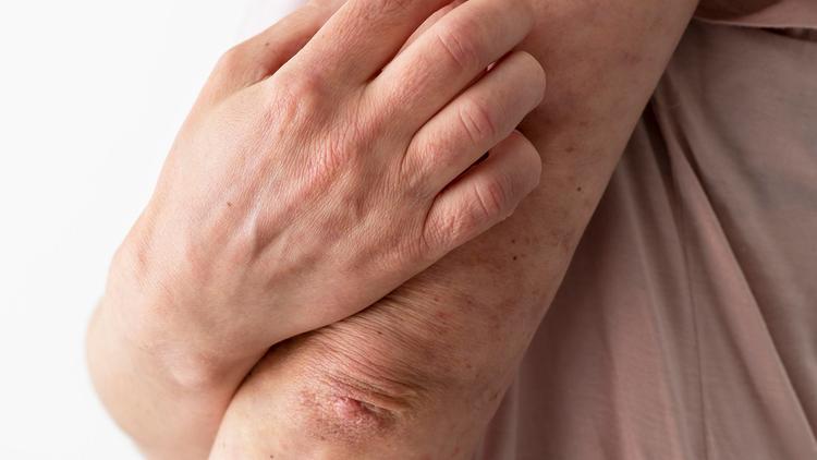 Prurigo: da definição ao tratamento