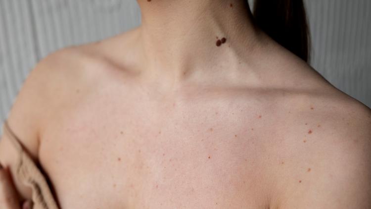 Uso da dermatoscopia no diagnóstico do melanoma