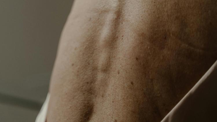 Mapeamento corporal total: ferramenta importante na detecção precoce do melanoma