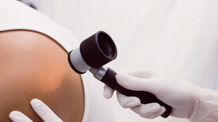 Dermatologista avaliando pápula acastanhada endurecida