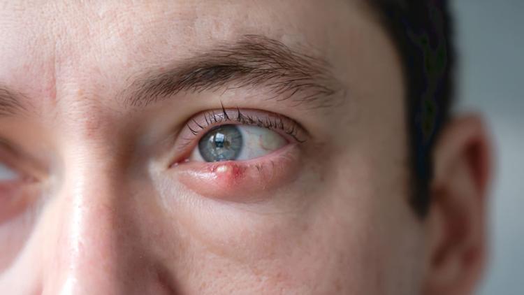 Dispositivo que auxilia o tratamento da blefarite- BlephEx ™