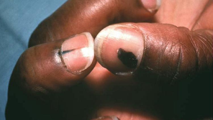 Melanoníquia: Abordagem diagnóstica e manejo