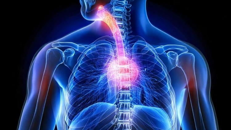 adenocarcinoma esofágico