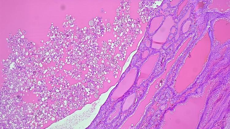 Classificação Bethesda (2023) para PAAFs de nódulos de tireoide