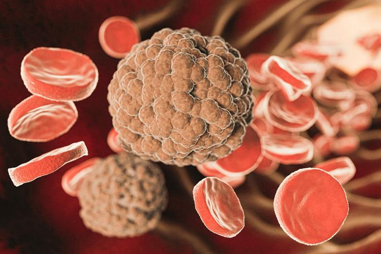 Características do Linfoma de Burkitt