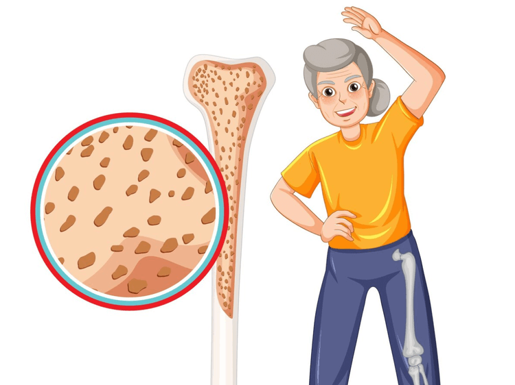 Diabetes e saúde óssea: atualizações da diretriz da ADA 2025