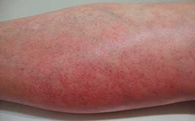 Doença de Schamberg : uma erupção purpúrica