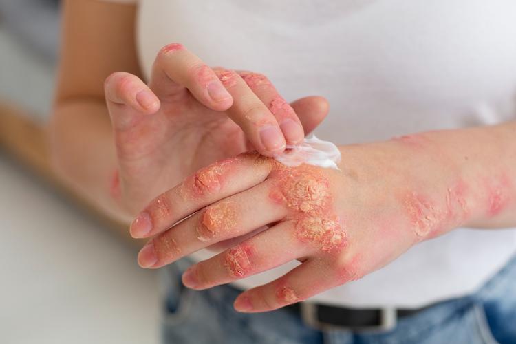 Dupilumabe no tratamento de dermatite atópica moderada a grave em crianças e adolescentes