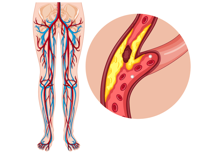 ISGLT2 aumenta o risco de amputação?