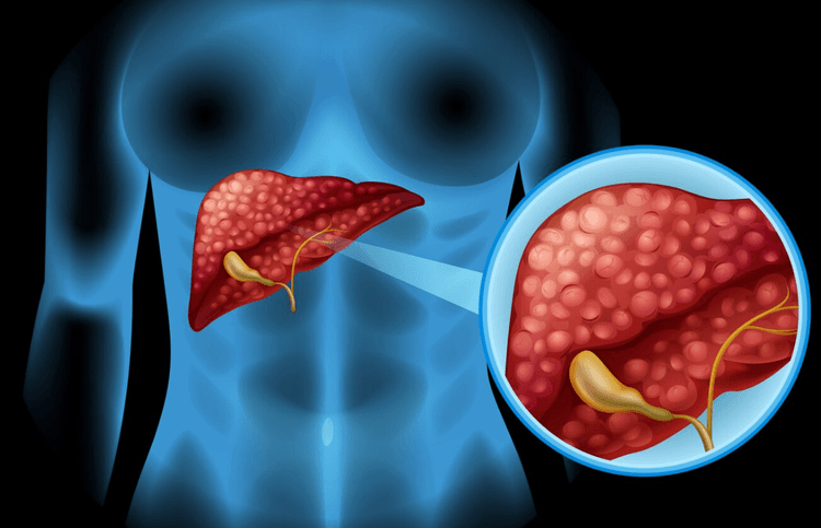 Nova diretriz da ADA 2025: quais as novidades sobre doença hepática esteatótica?